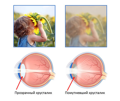 Зрение при катаракте