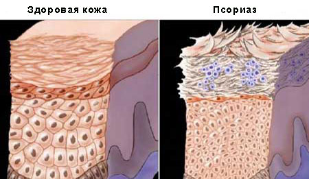 патогенез псориаза