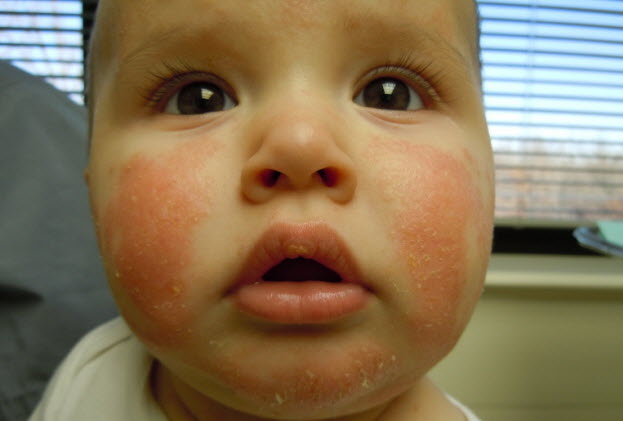 Ребенок с дерматитом