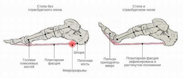 Что такое страсбургский носок. Смотреть фото Что такое страсбургский носок. Смотреть картинку Что такое страсбургский носок. Картинка про Что такое страсбургский носок. Фото Что такое страсбургский носок